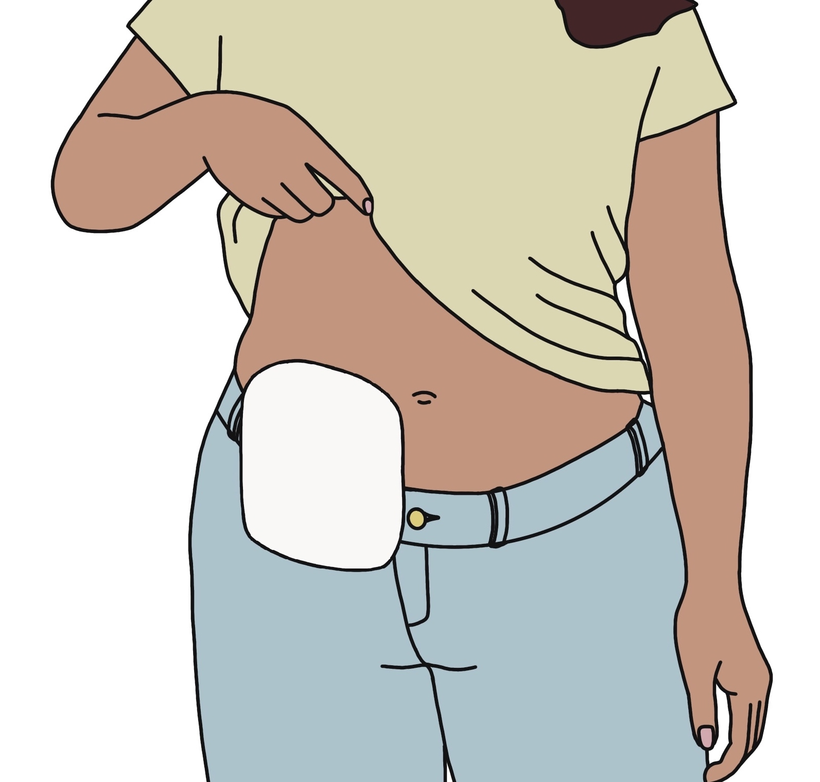 Illustrasjon av en person med stomi